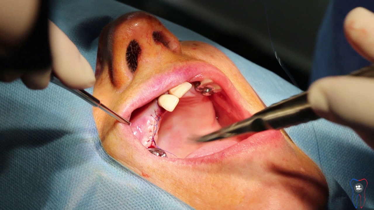 Implant dentaire : de quoi s'agit-il ?