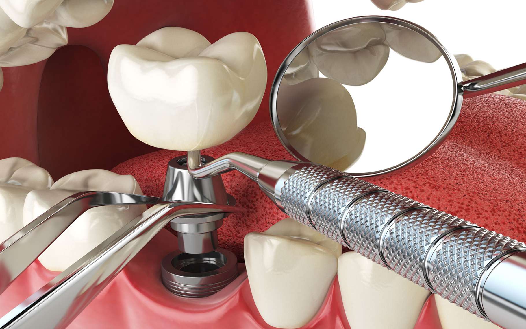 Implant dentaire : quel est son principal rôle ?